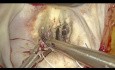 Endoscopic Mitral Valve Repair For Acute Chordal Rupture