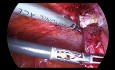 Laparoscopic Management of Small Bowel Adhesion
