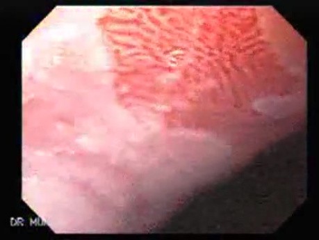 Barrett's Esophagus of long segment (8 of 24)