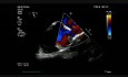ASD Sinus Venosus - Superior Vena Cava