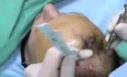 Hair Transplantation - implanter instrument adjustment