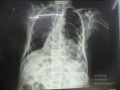 Diaphragmatic Hernia 