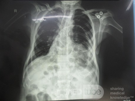 Diaphragmatic Hernia 