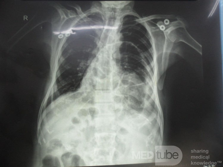 Diaphragmatic Hernia 