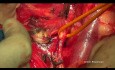 Ovarian Cancer Cytoreductive Surgery. The Hudson's Hysterectomy.