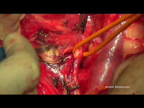 Ovarian Cancer Cytoreductive Surgery. The Hudson's Hysterectomy.