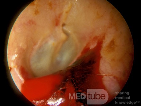 Laceration External Ear Canal with Fresh Clot Drying in the Canal