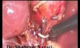 Hourglass Gallbladder
