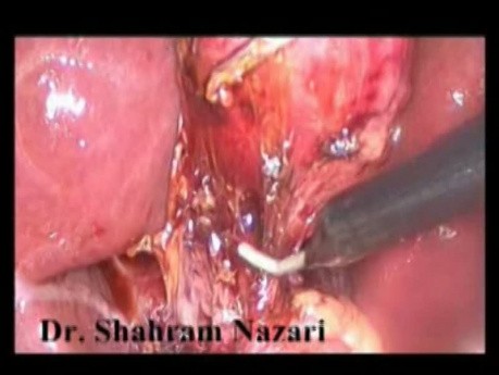 Hourglass Gallbladder