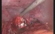Bilateral Inguinal Hernia Repair With Surgisis Mesh