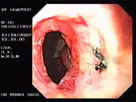 Zollinger- Ellison Syndrome - Gastric Ulcer with Gastrocolic Fistula (19 of 21)