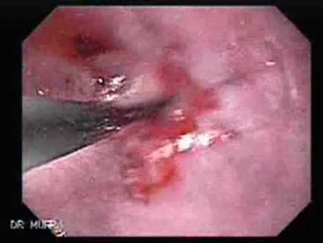 Endoscopic Baloon Dilation Of The Esophageal Stricture - Overcoming The Stricture