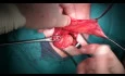 Open Inguinal Hernia