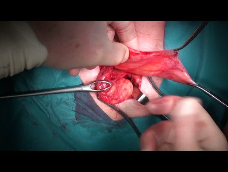 Open Inguinal Hernia