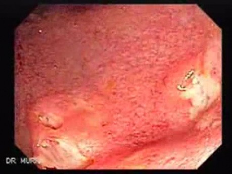 Multiple Rectal Ulcers (5 of 110)