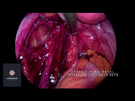 Endometriosis and Infertility Surgery