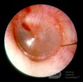 Early Acute Otitis Media [Stage of Redness]