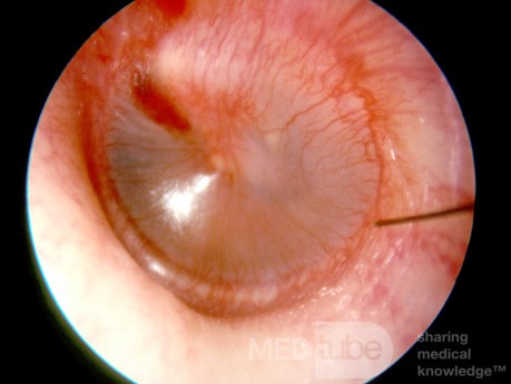 Early Acute Otitis Media [Stage of Redness]