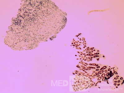 Non-Hodking Lymphoma B Cells. MALT (mucosa associated lymphoid tissue) (4 of 7)