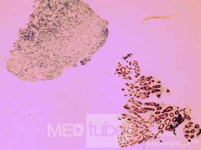 Non-Hodking Lymphoma B Cells. MALT (mucosa associated lymphoid tissue) (4 of 7)