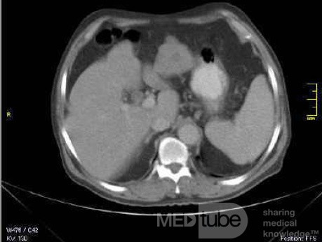 Gastrointestinal Stromal tumor (GIST) (13 of 13)