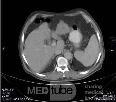 Gastrointestinal Stromal tumor (GIST) (13 of 13)