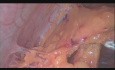 Total Laparoscopic Hysterectomy, Bilateral Salpingooophorectomy, Peritoneal Washings and Omental Biopsy