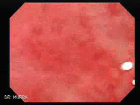 Post-Radiation Colitis (2 of 13)