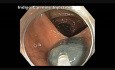 Subtle Flat Lesion EMR Injection