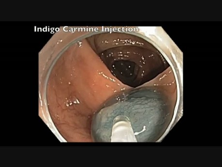 Subtle Flat Lesion EMR Injection