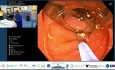 In Bloc Resection of a Large LST via SITE, Why Scope Stability Most Critical Tool??