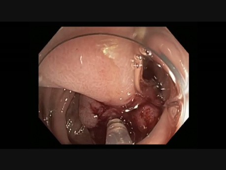 Colonoscopy - Sigmoid Polyp 3 - Epinephrine Injection