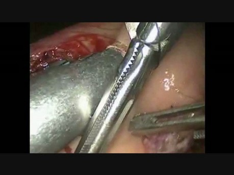 Laparoscopic Duodenopancreatectomy with Robotic Biliodigestive Anastomosis