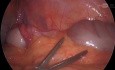 Laproscopic Appendectomy 01-  12 years Old Girl