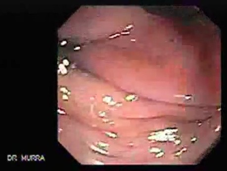 Colonoscopic Polypectomy (12 of 23)