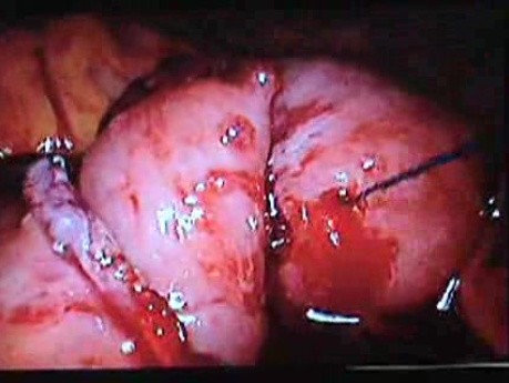 Jejunal Gastrointestinal Stromal tumor (GIST) (74 of 86)