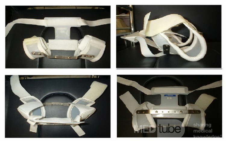 Hip Abductor Splint