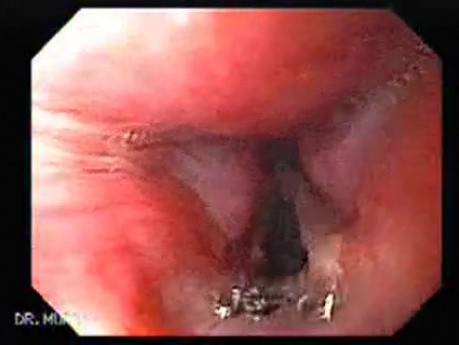 Laryngopharyngeal reflux (LPR) (1 of 2)