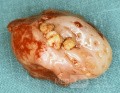 Tonsillolith [surgical specimen]
