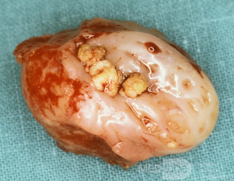 Tonsillolith [surgical specimen]