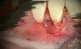 Periodontal Microsurgery: Grafting with Human Donor Dermis