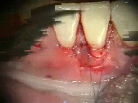 Periodontal Microsurgery: Grafting with Human Donor Dermis