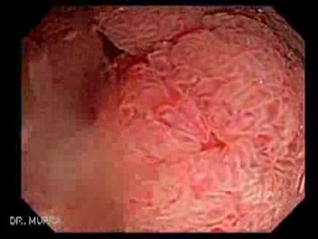 Giant Tubulo - Villous Adenoma (1 of 17)