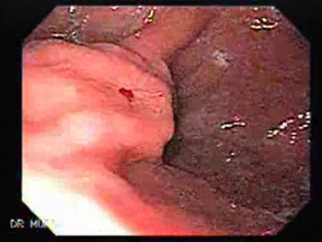 Gastric Varices - Endoscopic Ablation With Cyanoacrylate Glue (17 of 18)