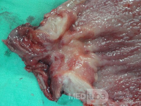 Gastric Ulcerated Adenocarcinoma of the Pre-pyloric Antrum (23 of 28)