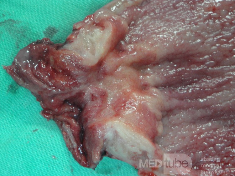 Gastric Ulcerated Adenocarcinoma of the Pre-pyloric Antrum (23 of 28)