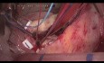 Tricuspid Carcinoid Disease, Endoscopic Surgery