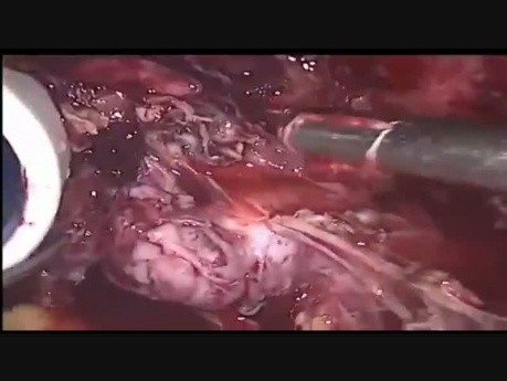 Ureteric Injury in Big 17×17 cm Cervical Fibroid