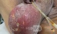 Fernier's Gangrene (Complicated Perianal Abscess)