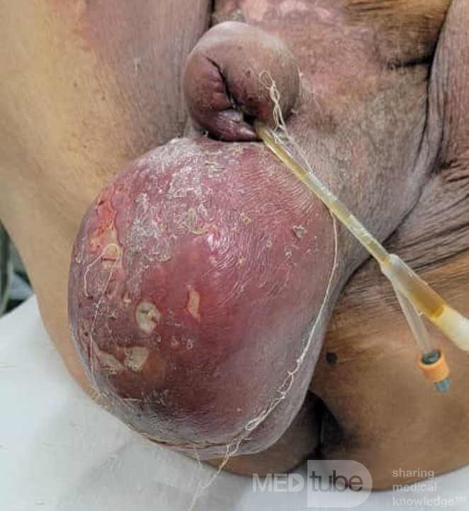 Fernier's Gangrene (Complicated Perianal Abscess)